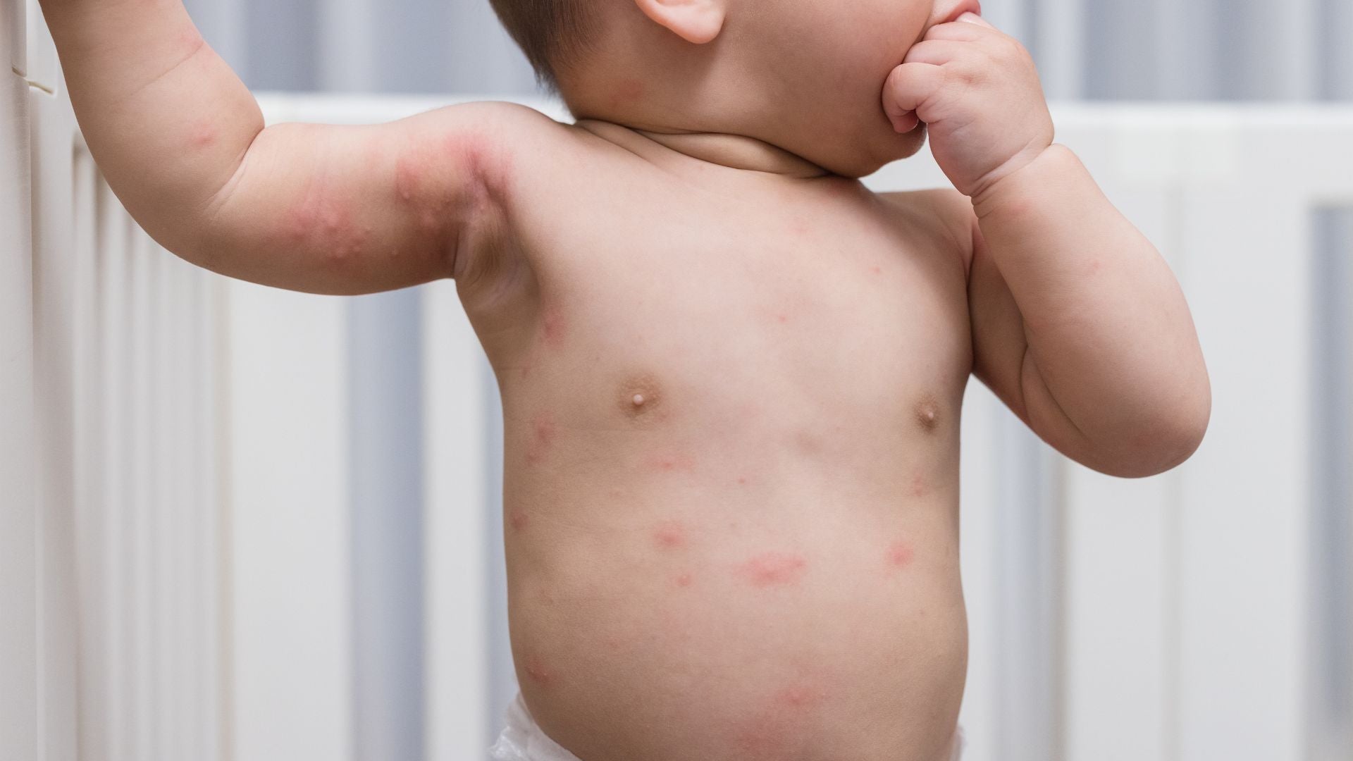 Éruption cutanée bébé : faut-il s'inquiéter ?