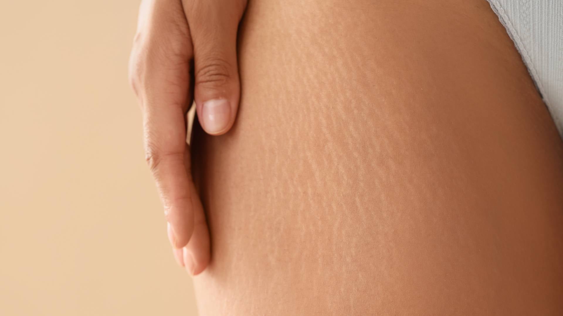 C'est quoi les vergetures chez la femme enceinte ?