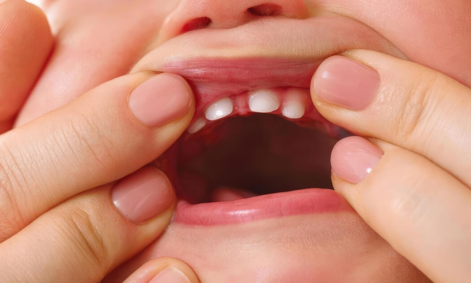 Quels sont les symptômes d'une poussée dentaire chez le bébé ?