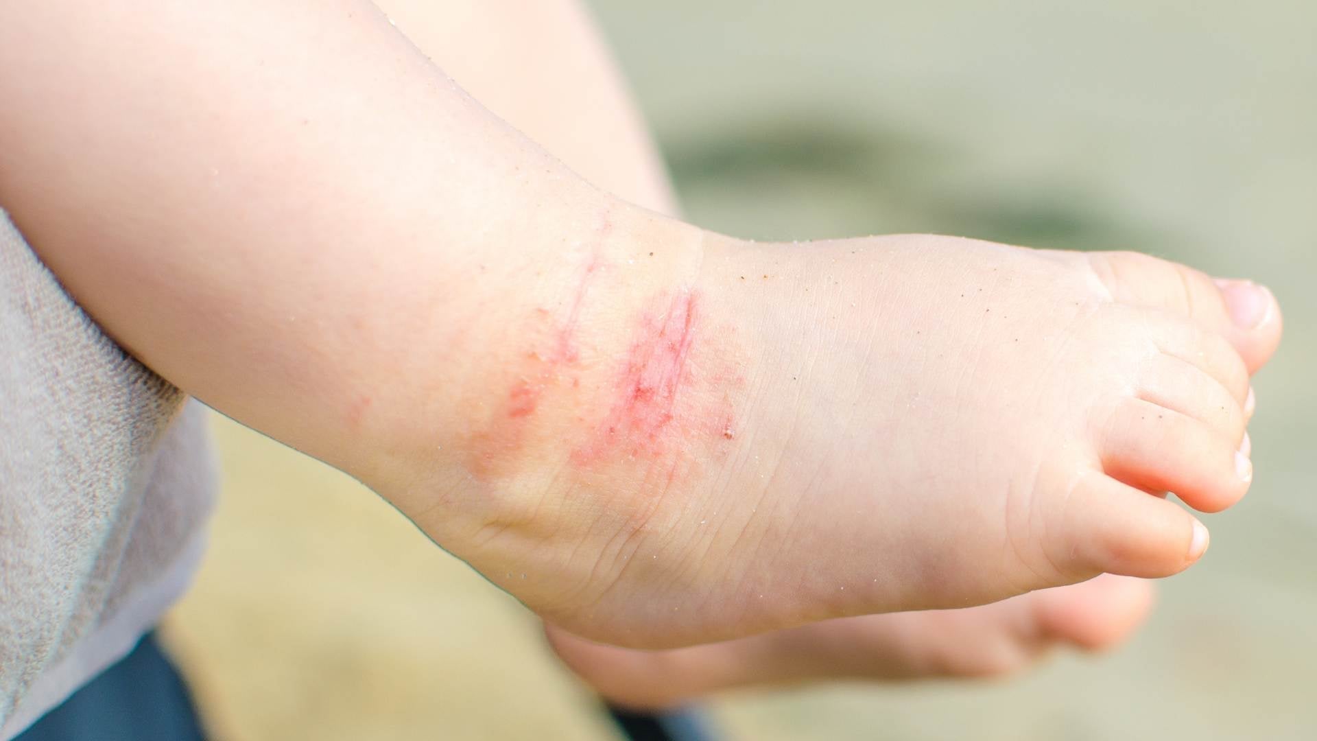 Peau atopique bébé : routine de soins + crèmes efficaces