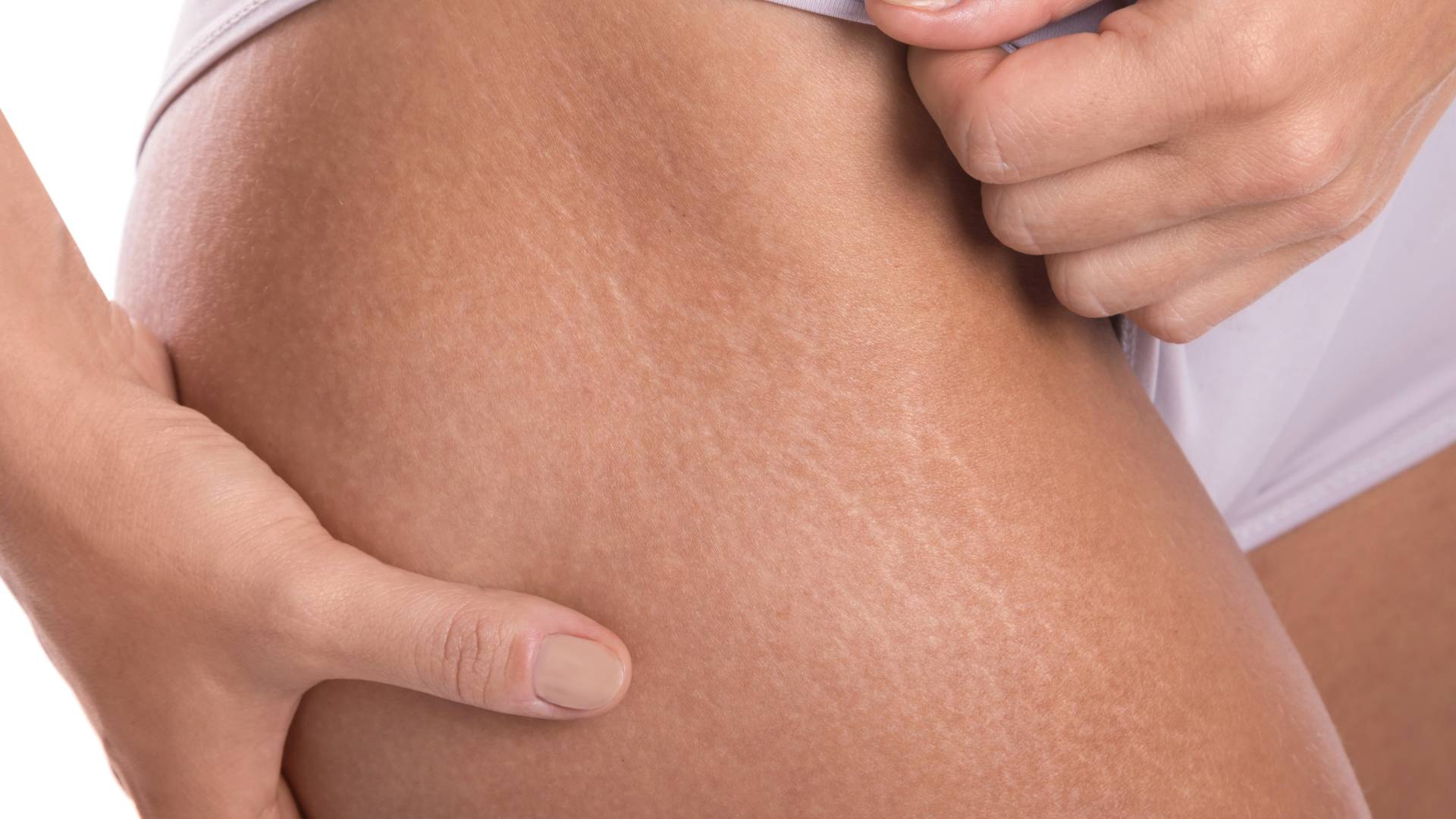 Vergetures : causes, solutions et conseils pour prévenir